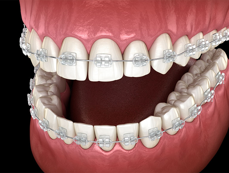 Ceramic Invisible Braces