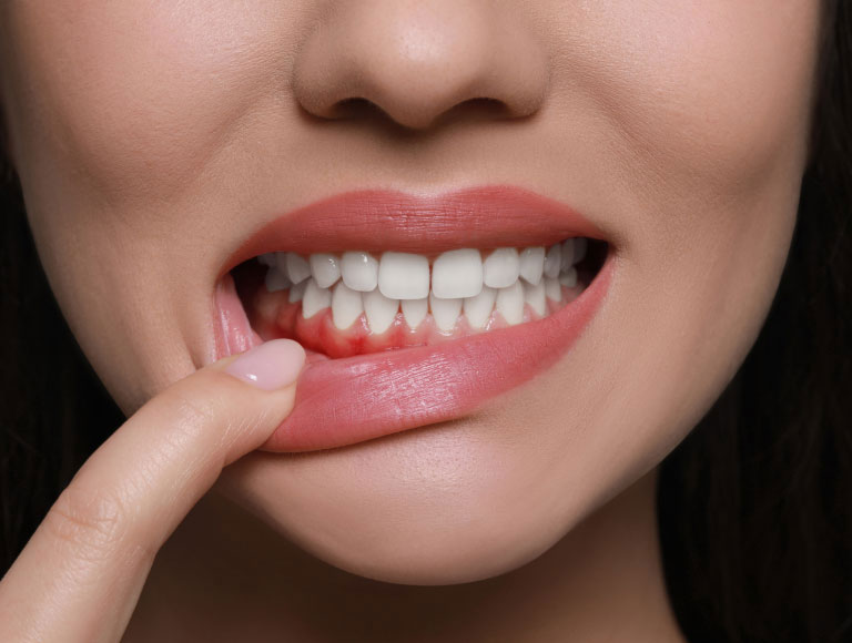 Gum Disease Symptoms