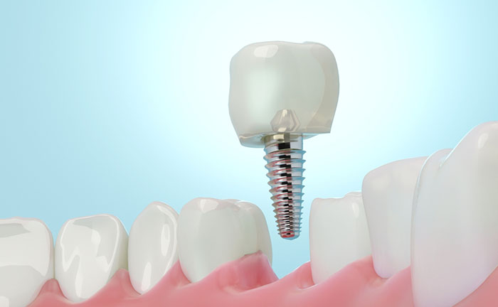 Replace Missing Teeth with Dental Implants