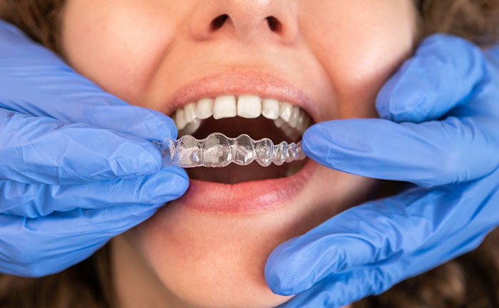 Reasons Patients Choose Invisalign Treatment