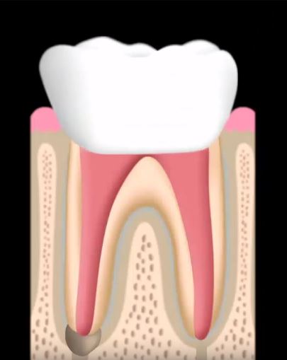 Costa Mesa Root Canal Therapy | Dentistry At Its Finest Costa Mesa Root Canal Therapy | Dentistry At Its Finest
