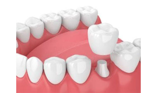 Dental Crowns For Bruxism
