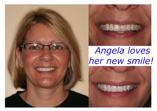 Dental Veneers 