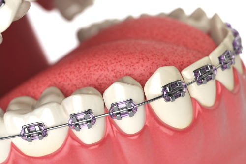What Do Rubber Bands Do on Braces? - OC Dental Center