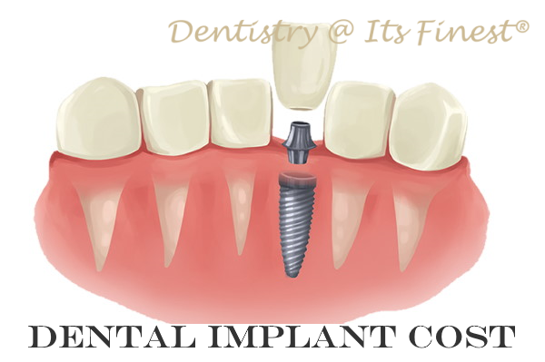 How Much Do Dental Implants Cost With Insurance  