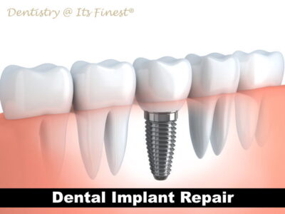 Dental Implant Repair