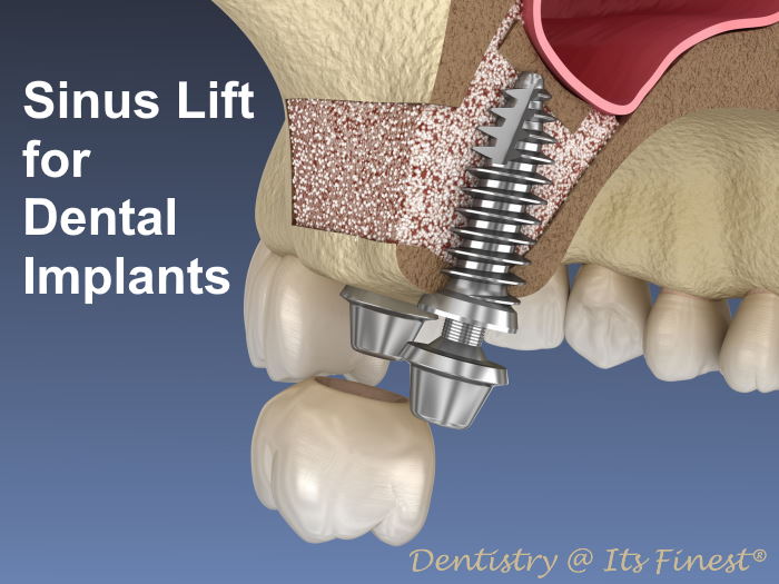Sinus Lift Surgery for Dental Implants