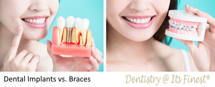 Dental Implants vs Braces