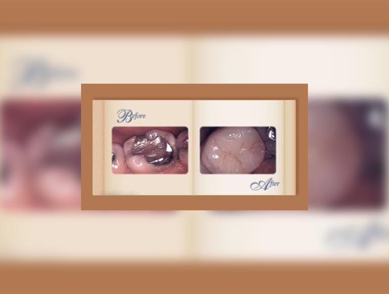 How Is a Dental Onlay Done?