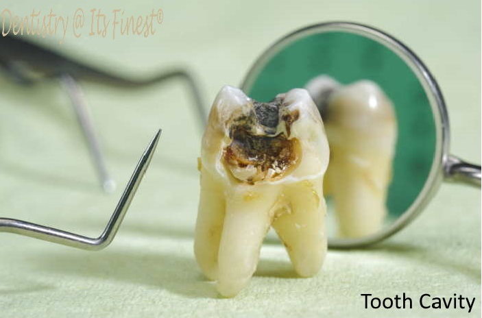 Cavity Dental Filling, Tooth Cavity