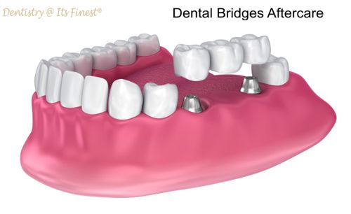 Dental Bridges Aftercare