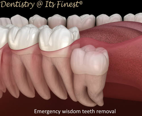 Emergency wisdom teeth removal in Costa Mesa