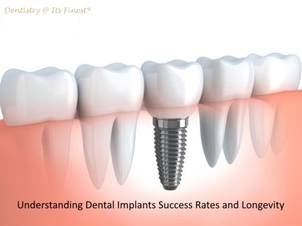 Understanding Dental Implants Success Rates and Longevity