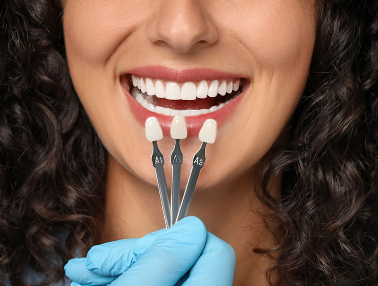 When Are Veneers used
