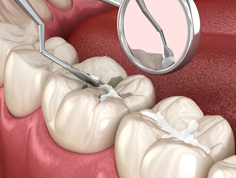 How Long Do Dental Sealants Last?
