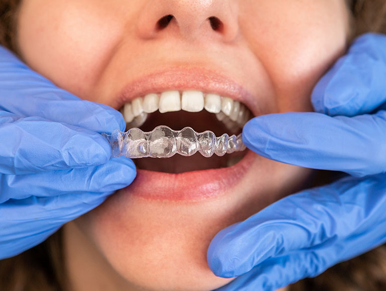 Invisalign First for Kids