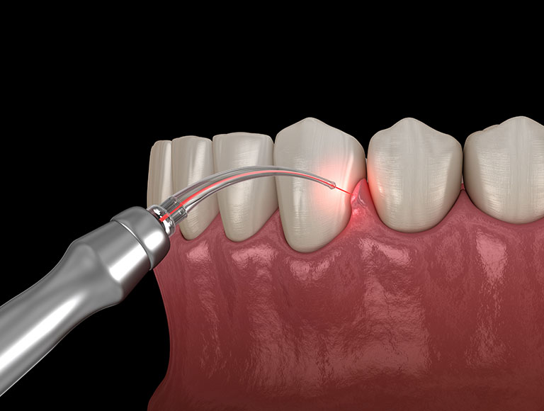 Laser Dentistry