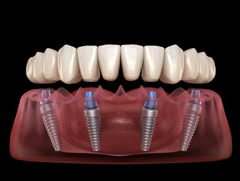 Natural Teeth Missing