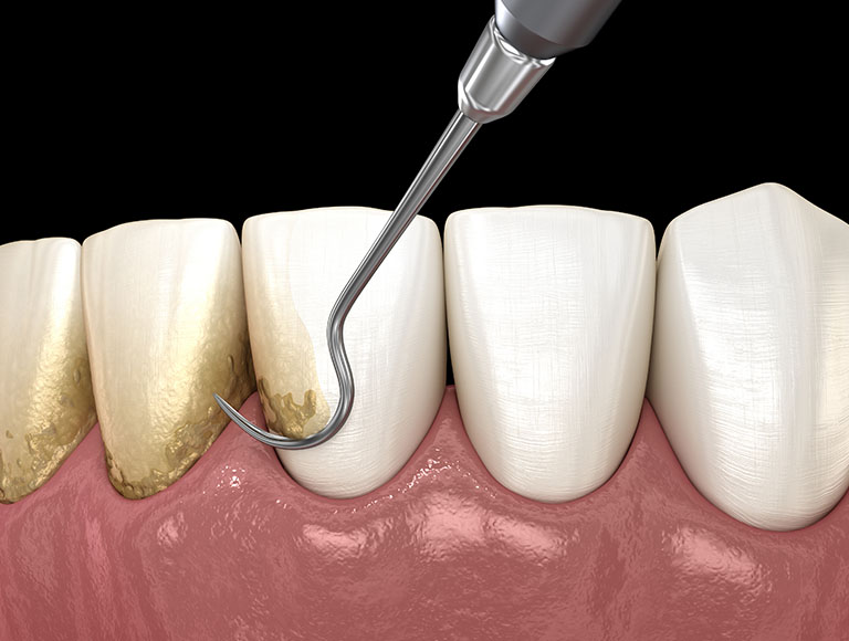 Periodontal Therapy