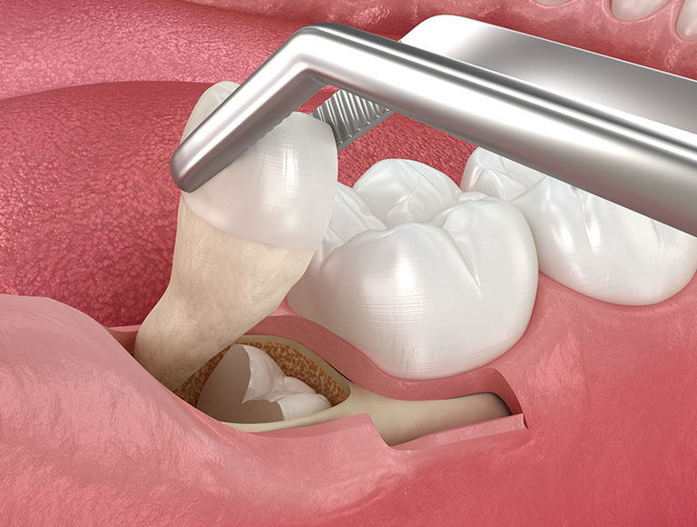 Teeth Removal Procedure