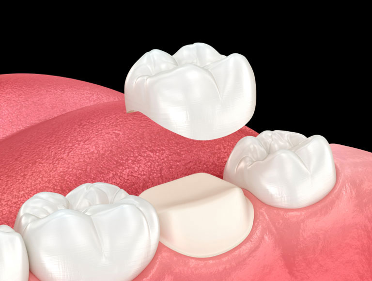 Affordable Dental Crowns Near Me in Costa Mesa, CA