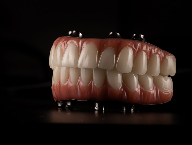 Full Mouth Dental Implants