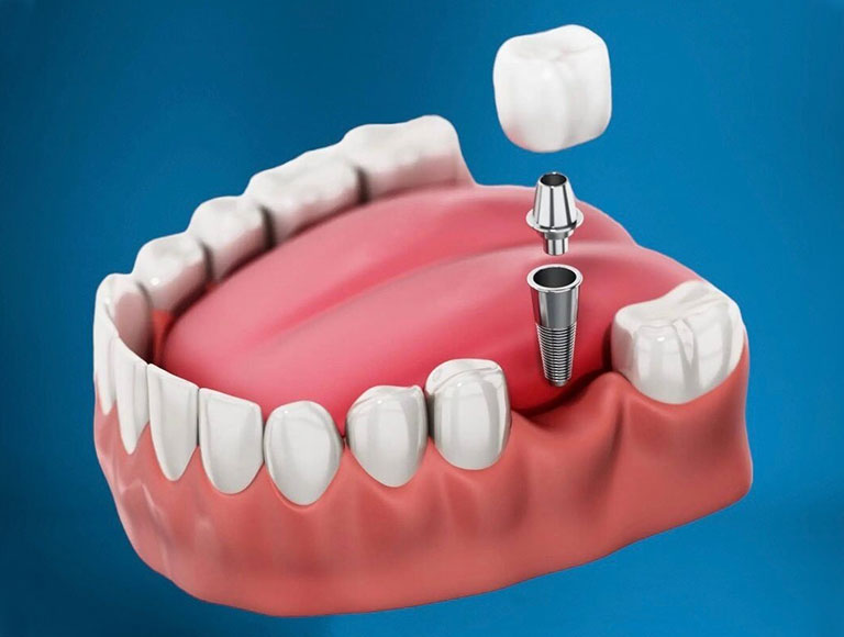 Tooth Implant in One Day?