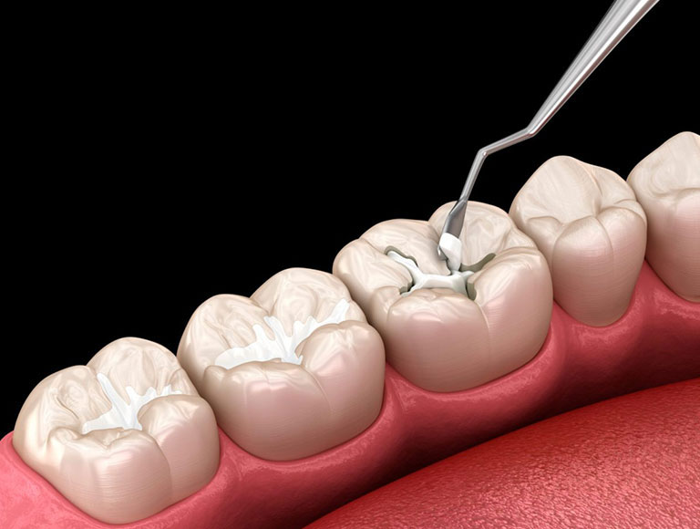 Sealants