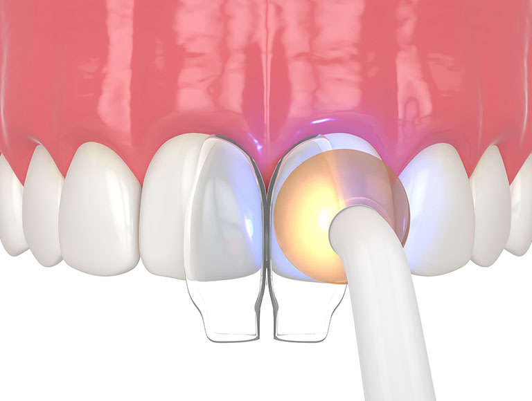Tooth Bonding