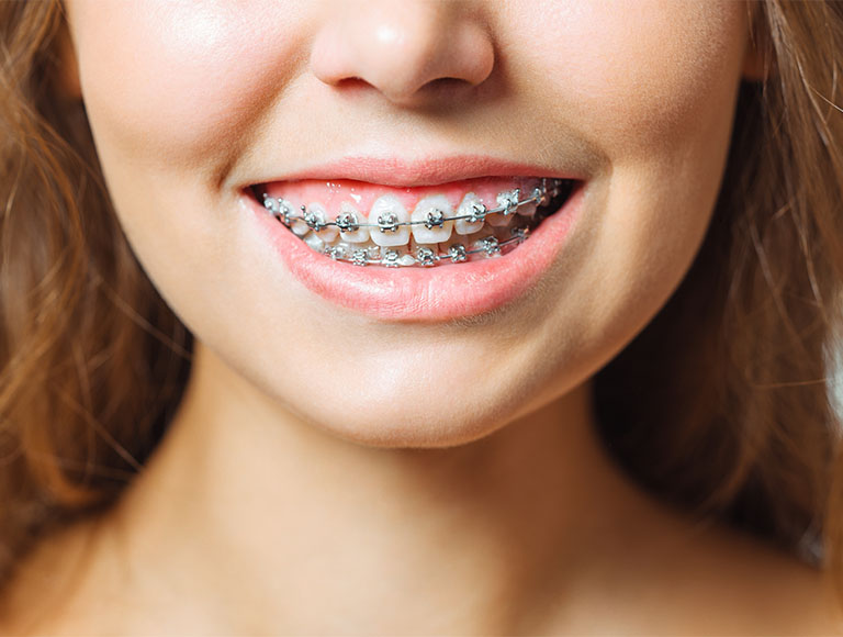 Metal Braces