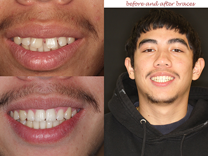Clear Braces