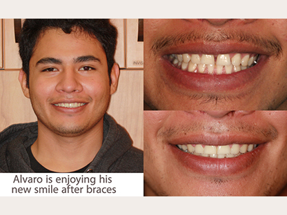 Clear Braces