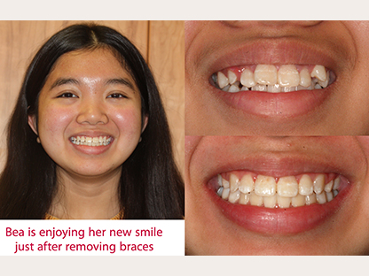 Clear Braces