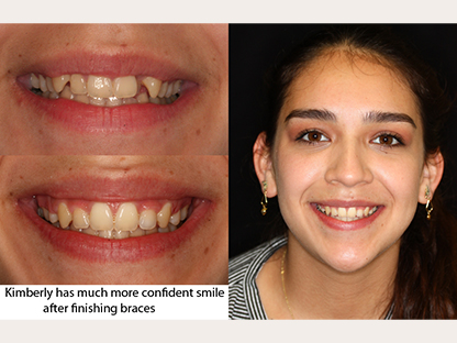 Clear Braces
