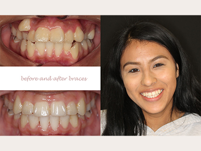 Clear Braces