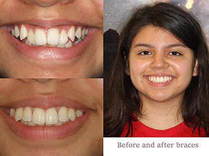Clear Braces
