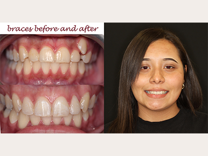 Clear Braces
