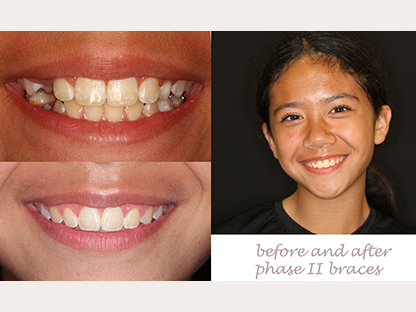 Clear Braces