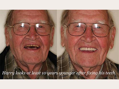 Dentures