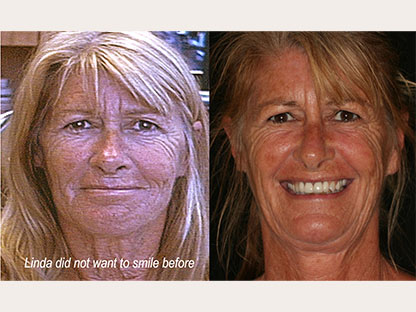 Dentures
