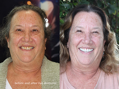 Dentures