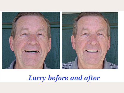 Dentures