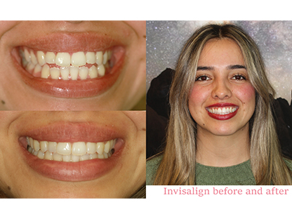 Invisalign treatment