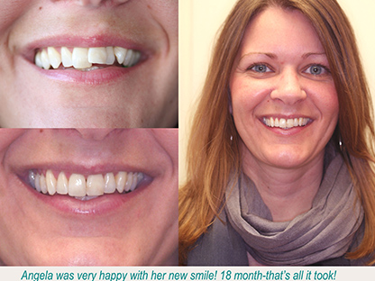 Invisalign treatment