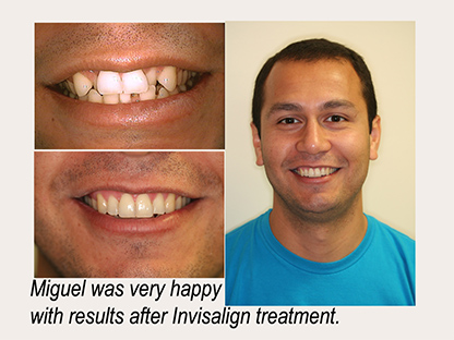 Invisalign treatment