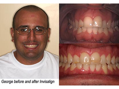Invisalign treatment