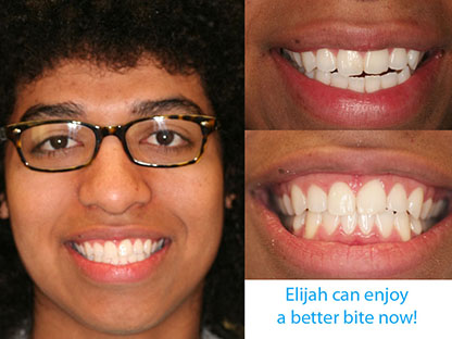Invisalign treatment