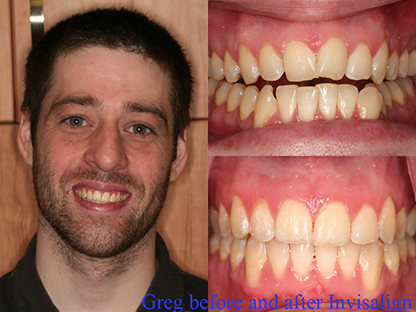 Invisalign treatment
