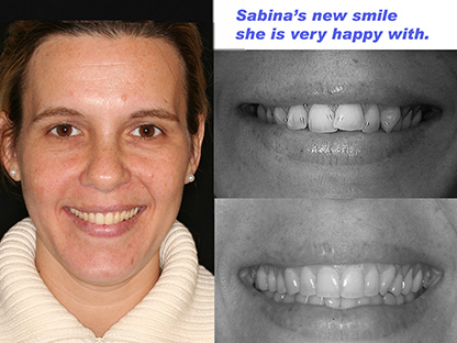 Invisalign treatment