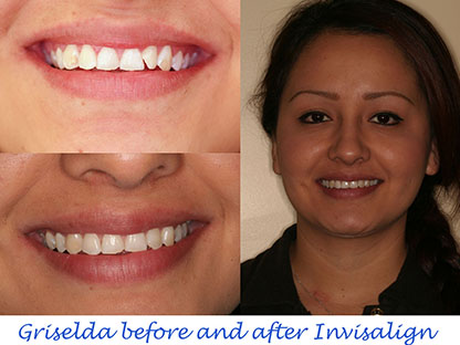 Invisalign treatment